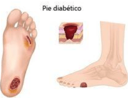 Pie diabético