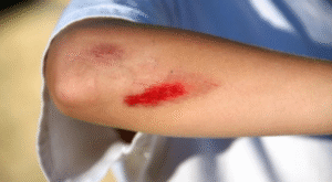 Cuidado experto para el tratamiento de heridas